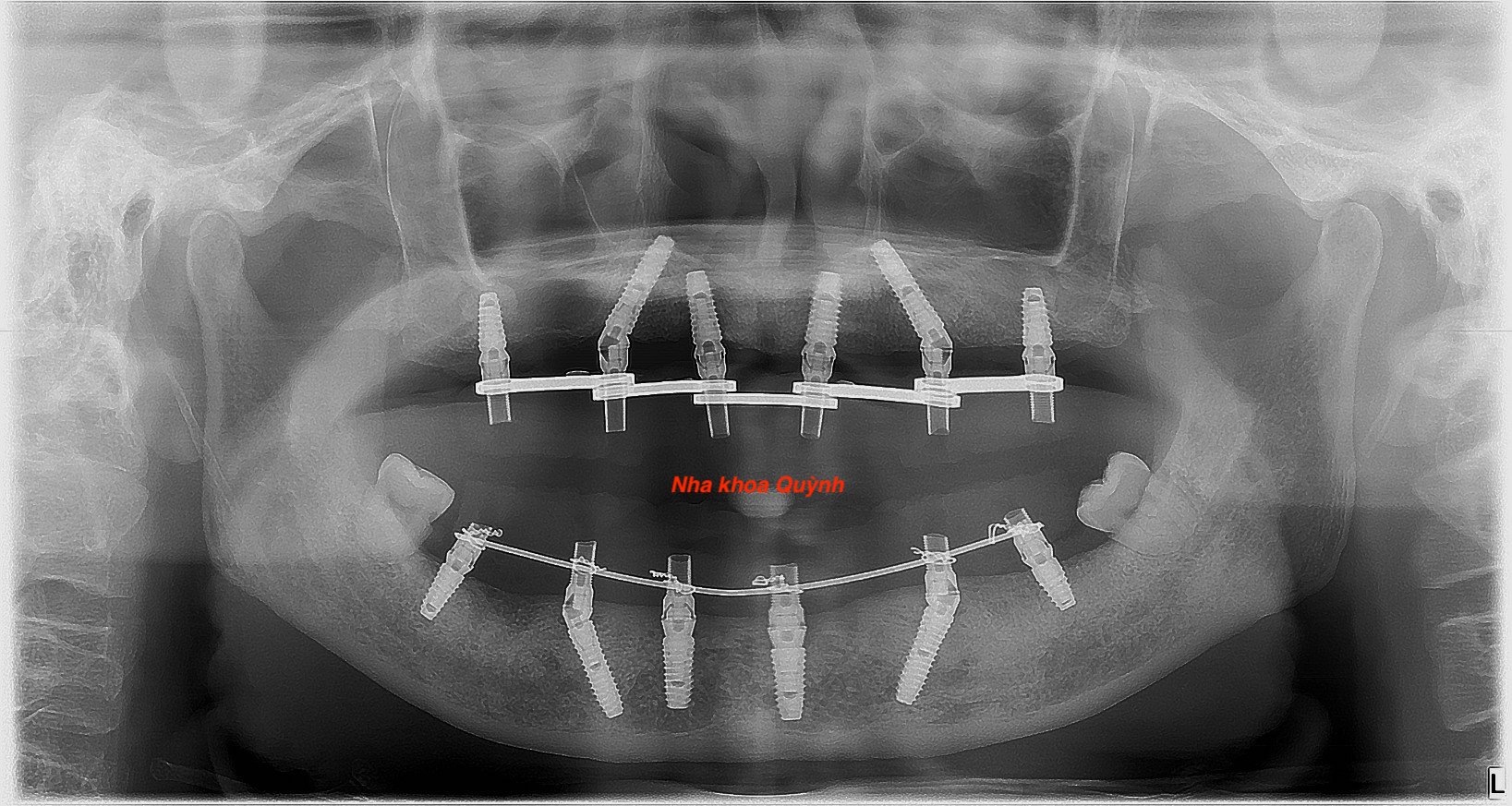 Trồng răng Implant 2 hàm , có ngay răng sau 2 ngày 