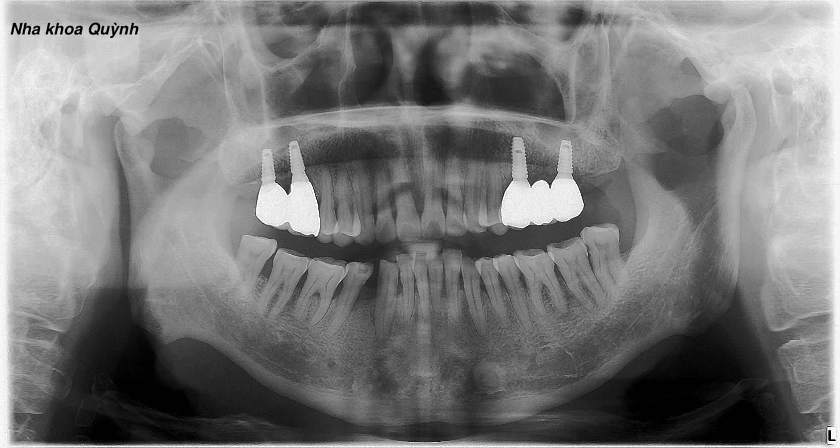 Mọc lại răng hàm nhờ trồng implant 